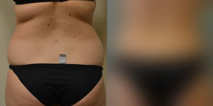 Abdominoplasty with Liposuction
