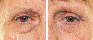 My Perfect Facial Before and after