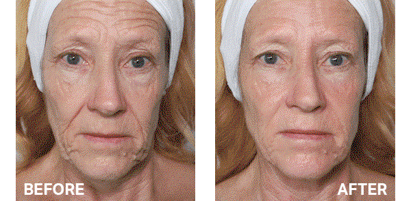 My Perfect Facial Before and after