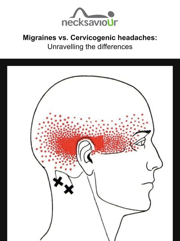 Migraines vs. Cervicogenic Headaches: Unravelling the Differences