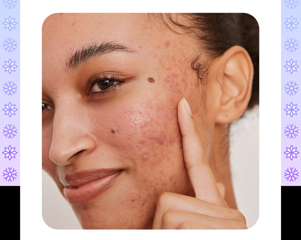 Woman points to a Peace Out Acne Healing Dot on her face.