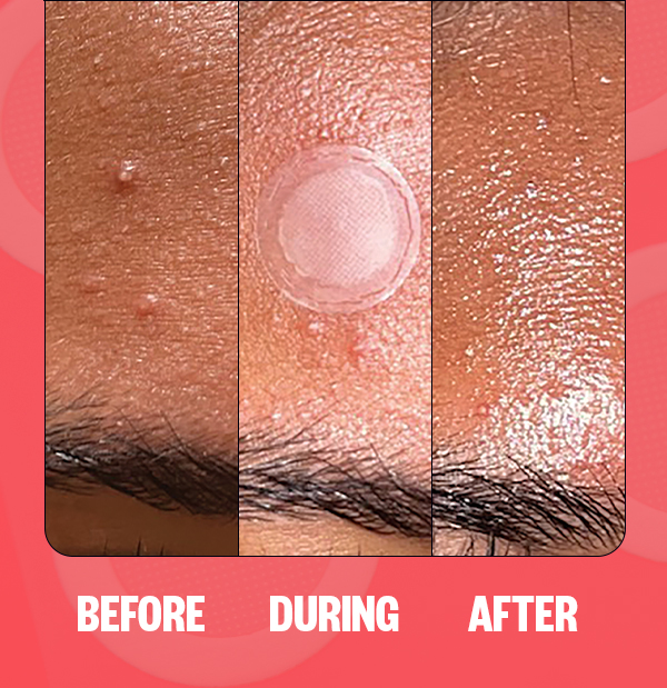 Model before, during, and after wearing the Early Stage Acne Dot