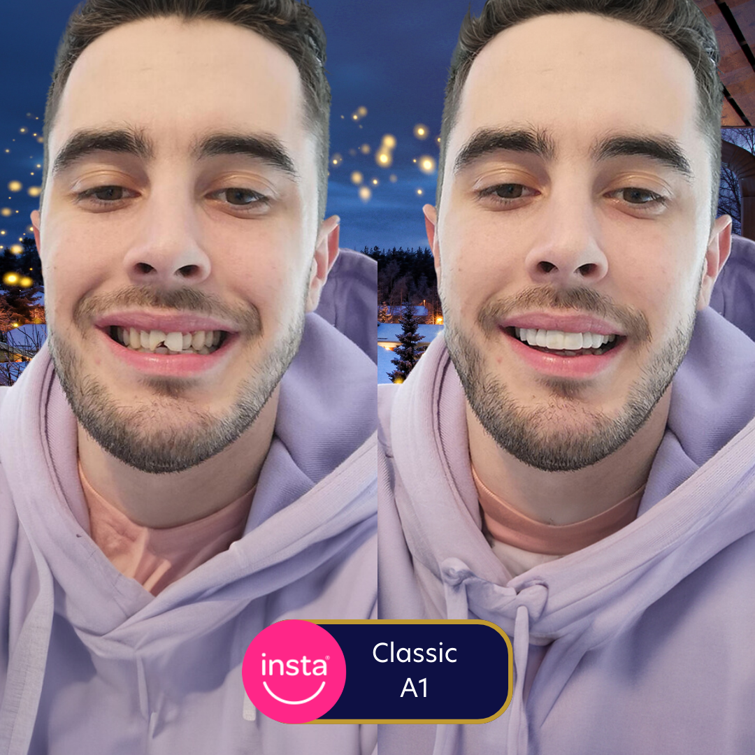 INSTAsmile (US) Hey —, How Long Will Your ClipOn Veneers Last? ⏰ Milled