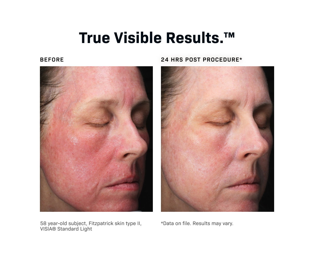 Revision Skincare: Introducing CMT Post-Procedure Cream™ | Milled