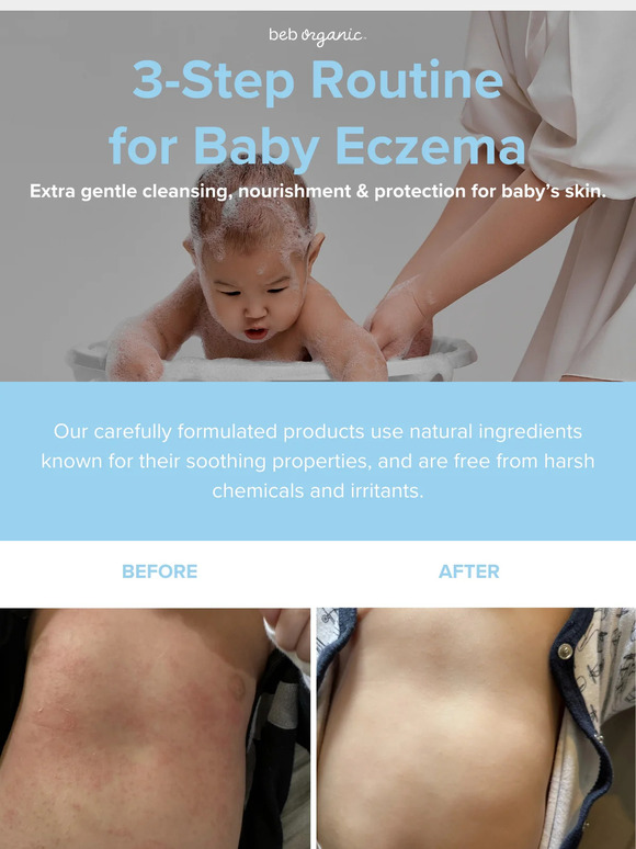 Discover the Secret to Soothing Baby Eczema