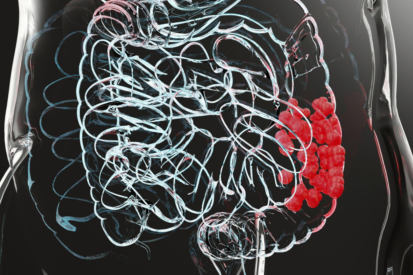 Illustration of a cancerous area of the bowel