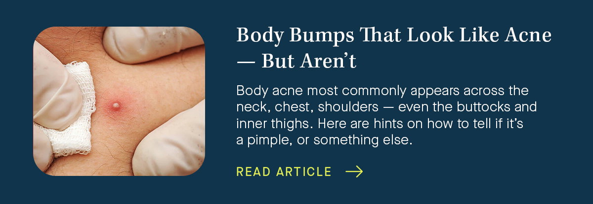 SLMD Skincare: 🆘 What are those bumps on my body? | Milled