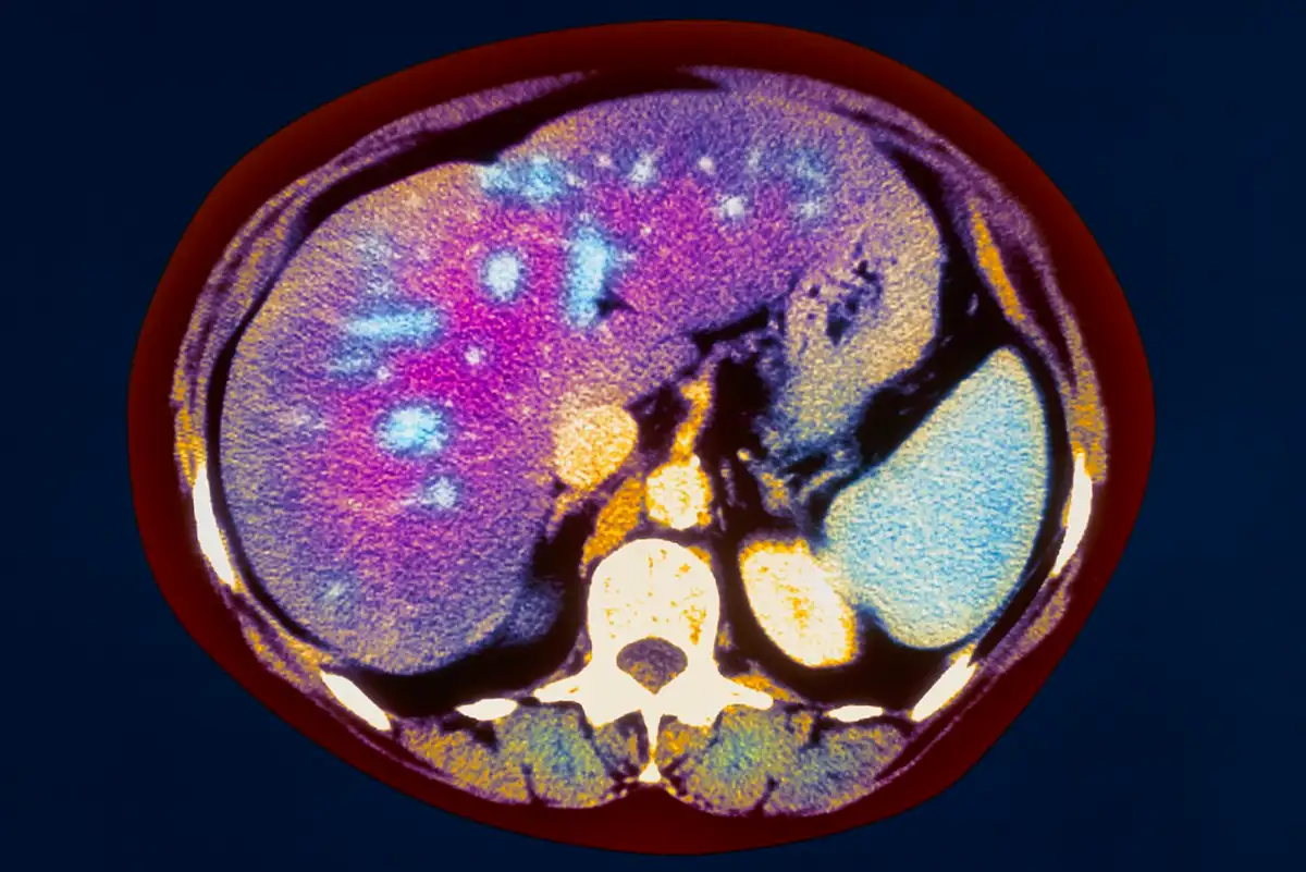 Why you may have a stealth liver disease and what to do about it. Image leads to article.