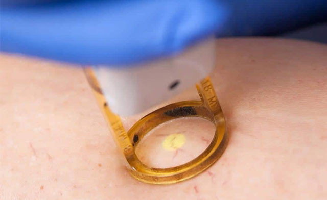 Spider Vein Removal