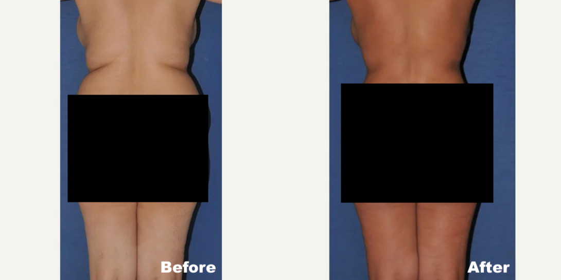 45-54 year old woman treated with Brazilian Butt Lift