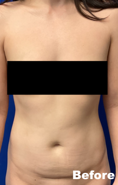 Tummy tuck