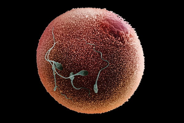 False-coloured scanning electron micrograph of a human spermatozoa fertilising an egg.