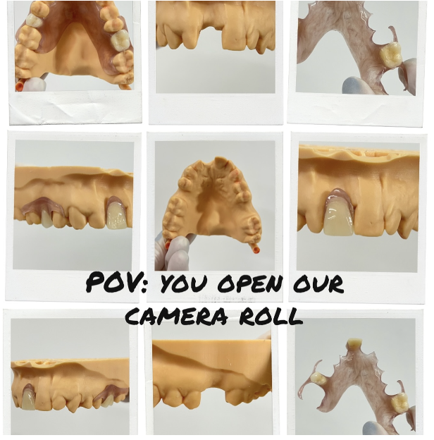 Flexi Denture for 3 missing teeth 
