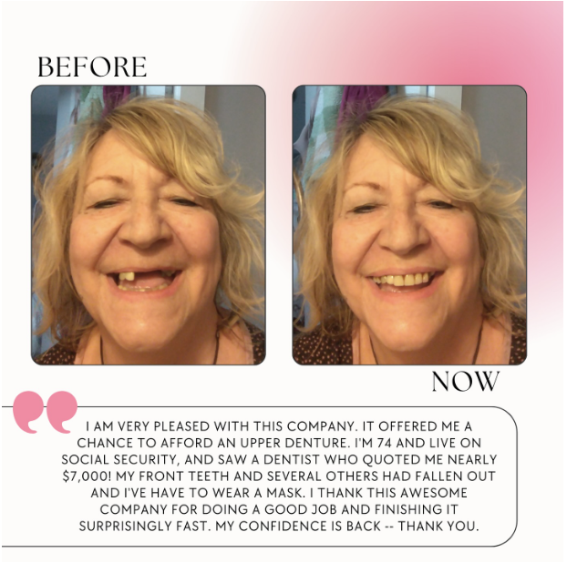 Before and after Flexi Denture 