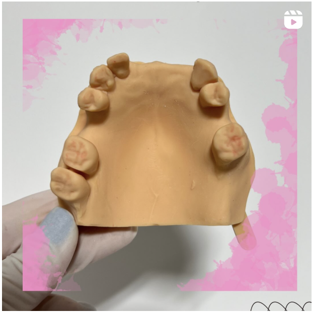 Flexible Denture for 6 missing teeth 