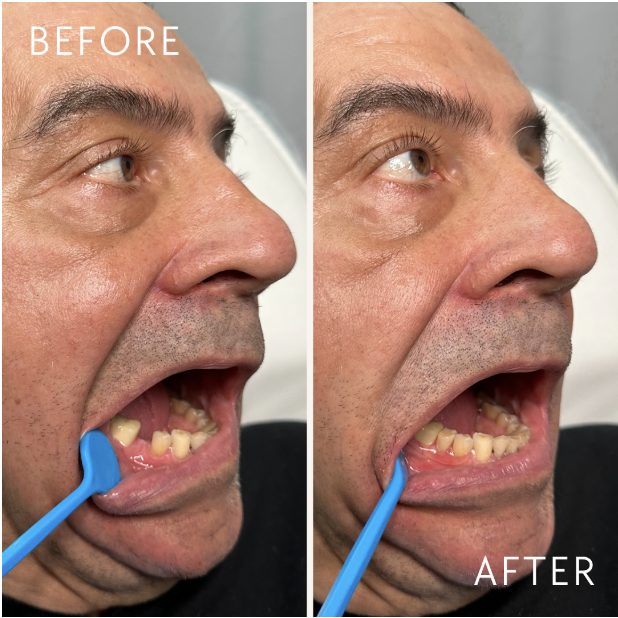 Flexi Flipper Before and After 