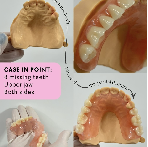 Flexi Denture for 8 missing teeth 