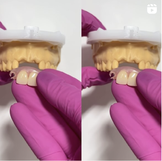Flexi Flipper for Front missing teeth