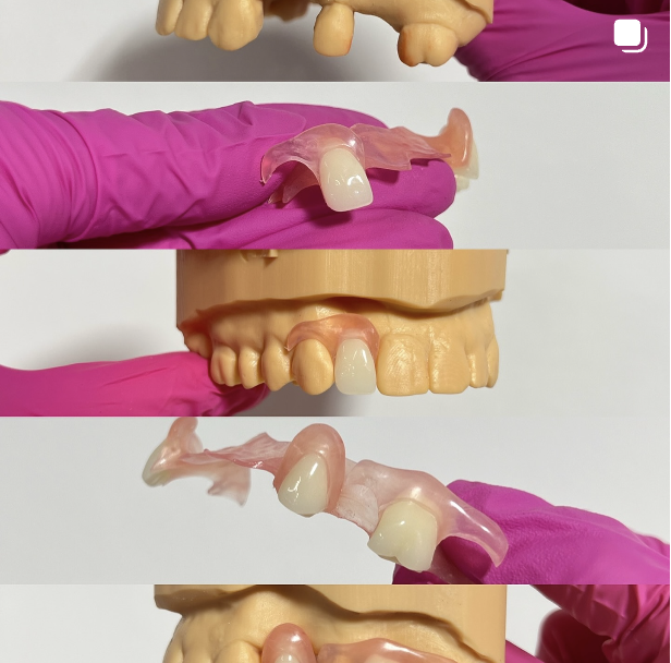Flexible Denture for 3 randomly missing teeth 