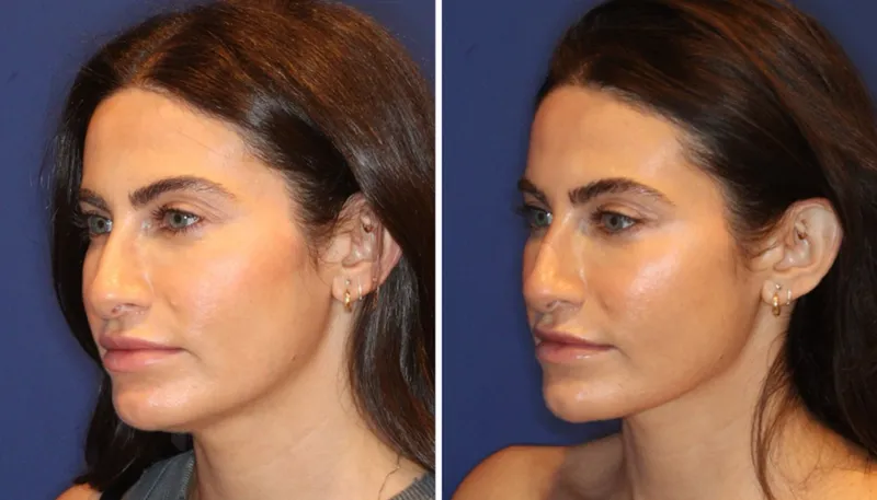 I Tried the “Nefertiti Lift” to Define My Jawline