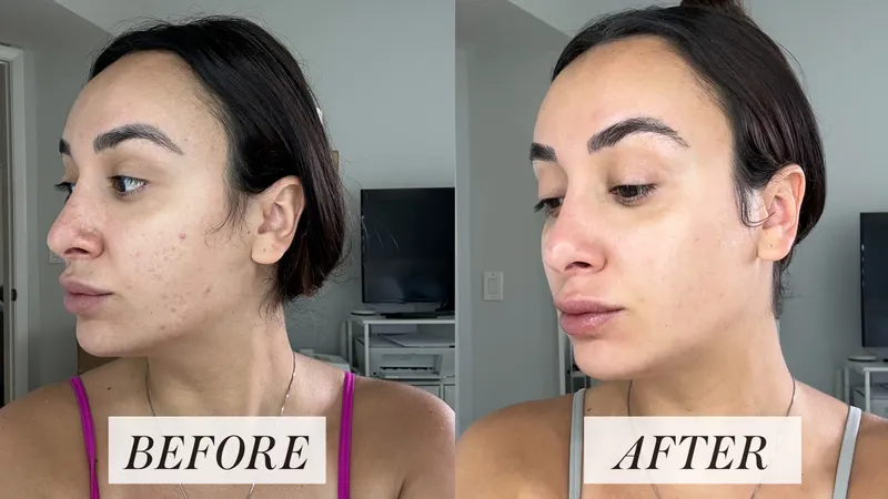 angela trakoshis selfie before using tretinoin rotuine and after
