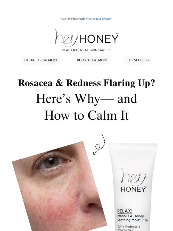 Rosacea & Skin Redness Flaring Up? We've Got You Covered.