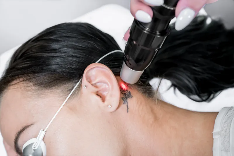 I Got Laser Tattoo Removal Treatments to Erase a Memory of My Ex