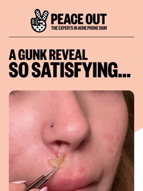 😱 4M+ Views & a Gunk Reveal You Need to See