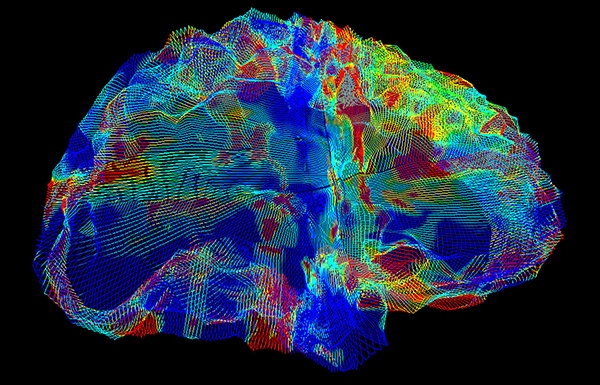 Coloured DTI MRI scan showing white matter fibres in the brain of a patient with Alzheimer's disease.