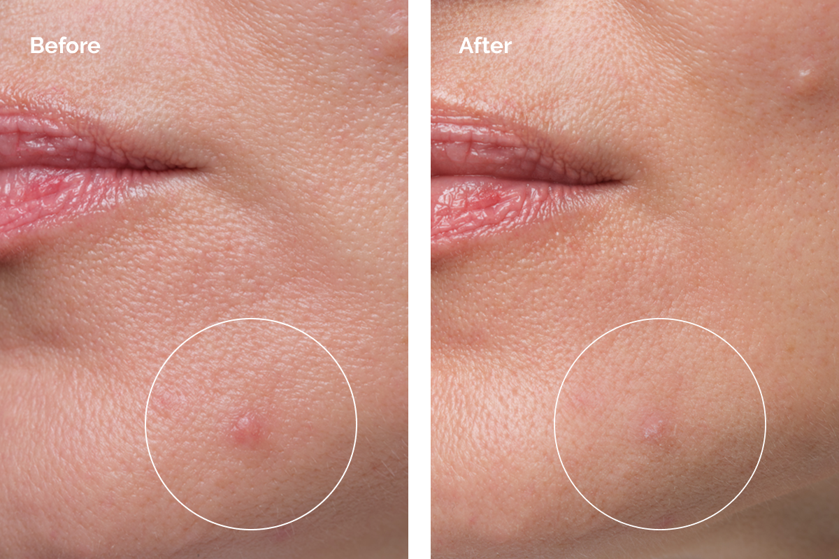 Before & After Sulfur 10% use
