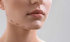 Double-Chin Reduction Injection – One Vial of Deoxycholic Acid, 72% Off at Skinovatio Gold Coast 