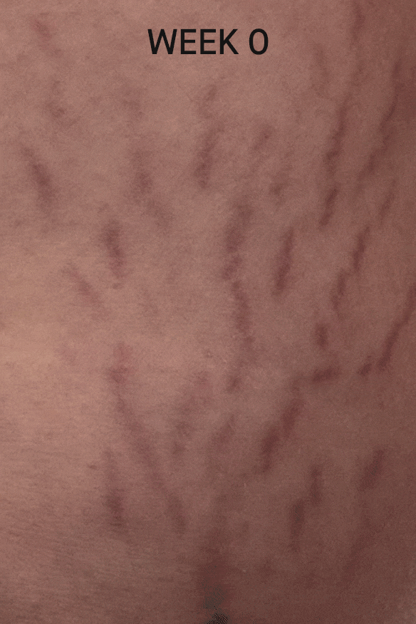 Stretch Mark Reduction