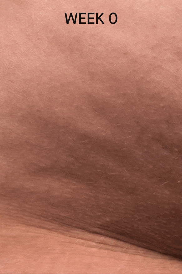 Cellulite Reduction