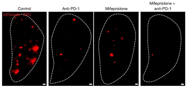 A figure showing the growth of metastatic breast cancer cells in the lungs of mice given various treatments, including the immunotherapy anti-PD-1, mifepristone and both drugs together. 
