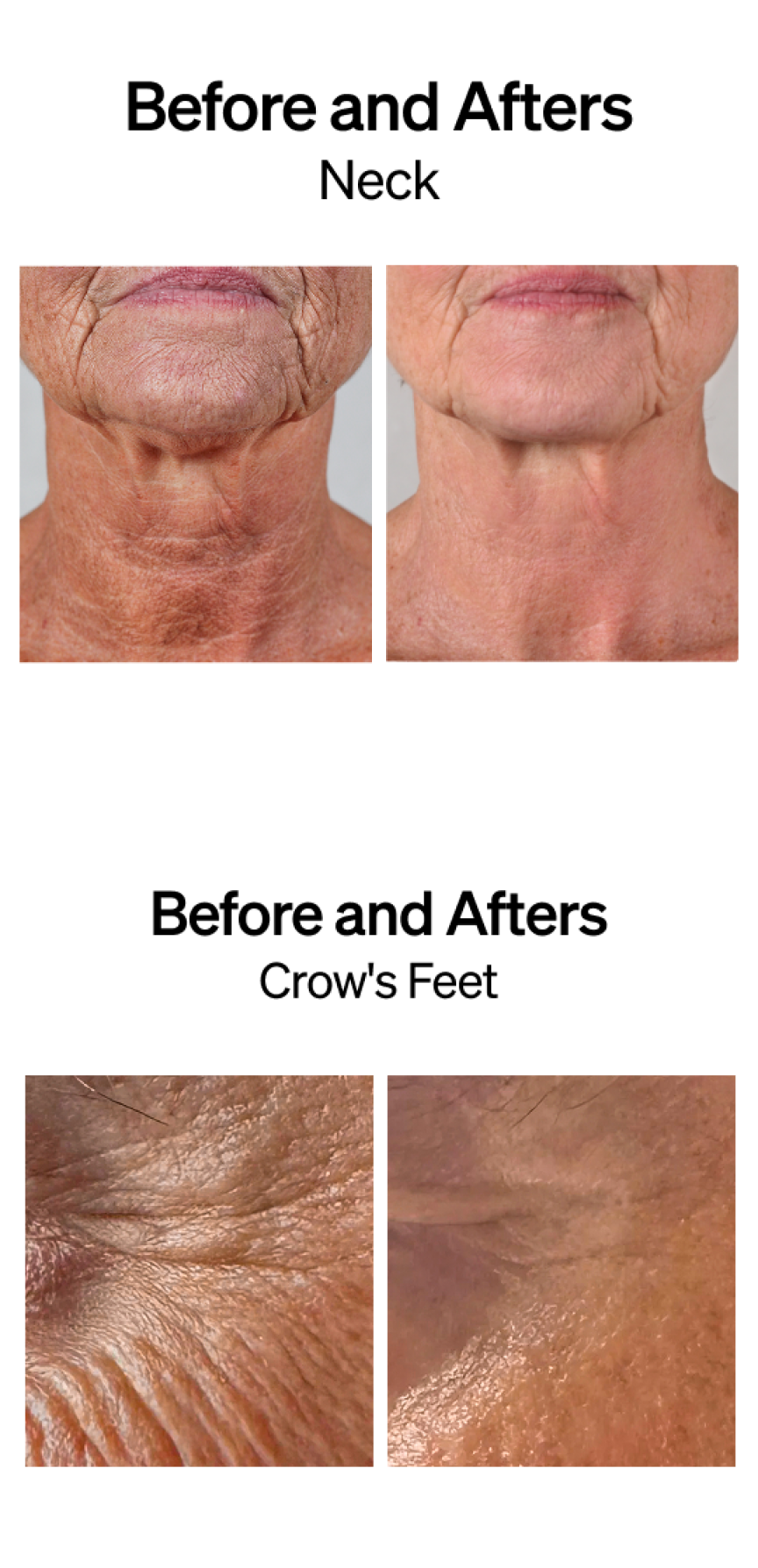Before and After pictures of neck and crow's feet