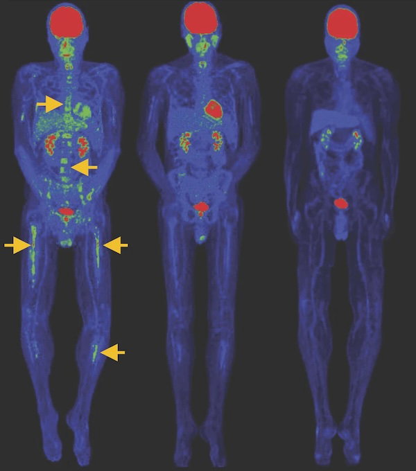 A PET/CT scan showing the reduction in the size of bone lesions over time following the infusion of enriched CAR T cells.