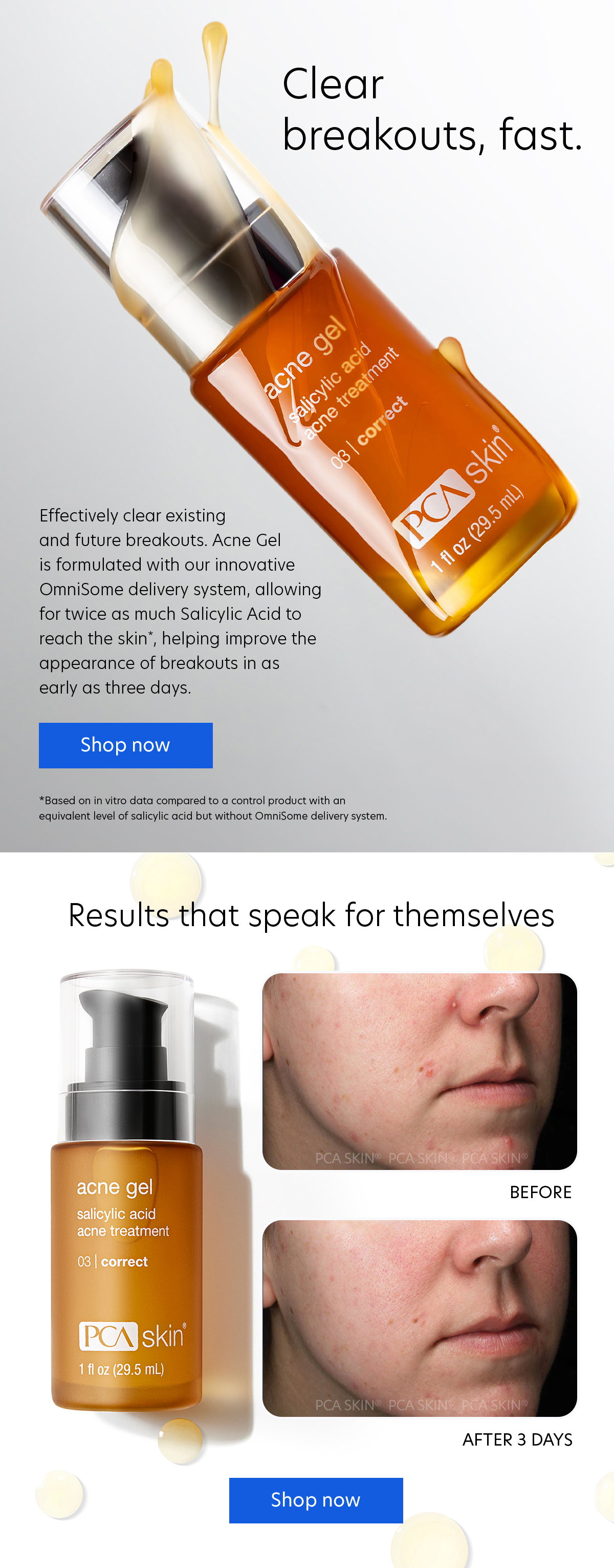Acne Gel