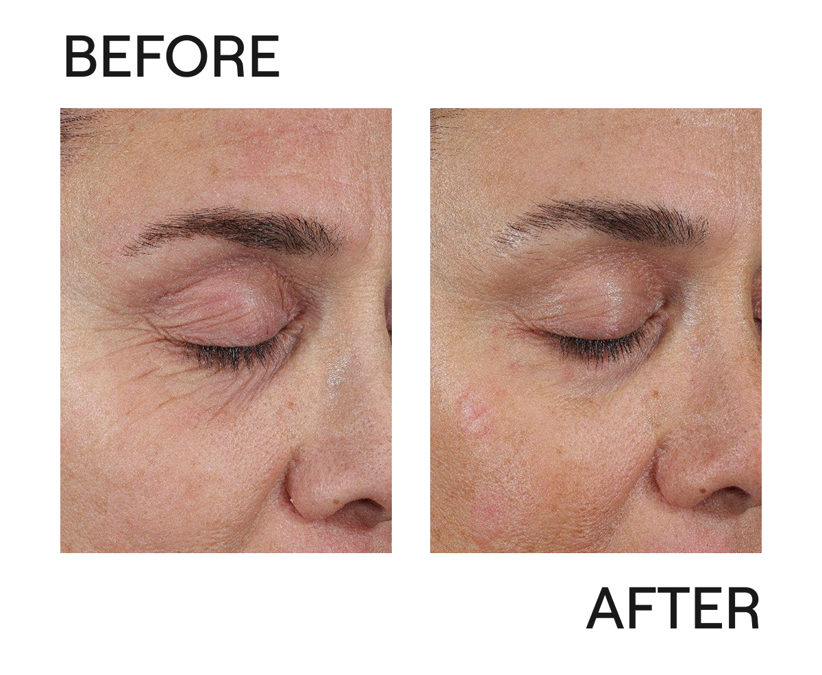EyeLift
