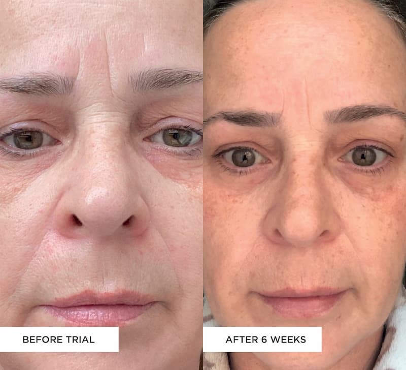 BEAUTYPRO LED mask results before and after