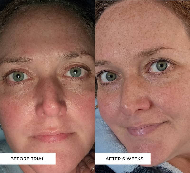 BEAUTYPRO LED mask results before and after