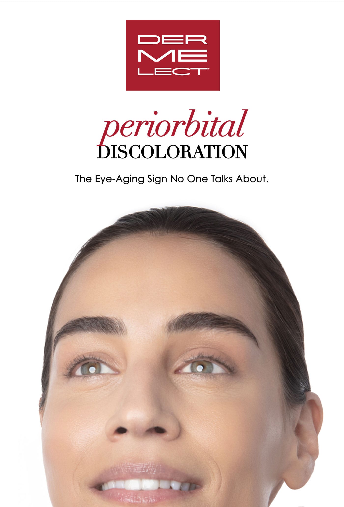 Periorbital Discoloration