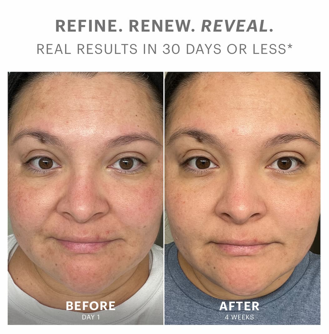 REFINE. RENEW. REVEAL. REAL RESULTS IN 30 DAYS OR LESS*  BEFORE: DAY 1  AFTER: 4 WEEKS