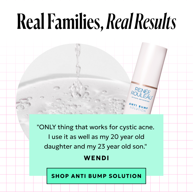 Anti Bump Solution: "ONLY thing that works for cystic acne. I use it as well as my 20 year old daughter and my 23 year old son." - Wendi