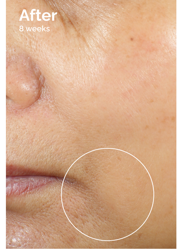 After 8 weeks using  Caffeine 3% + Escin 1% Face Serum