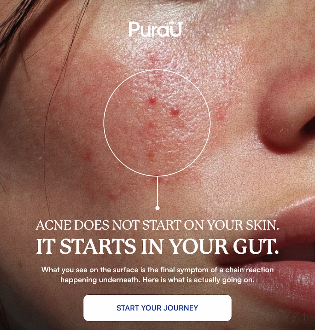 ACNE DOES NOT START ON YOUR SKIN. IT STARTS IN YOUR GUT. | Start Your Journey