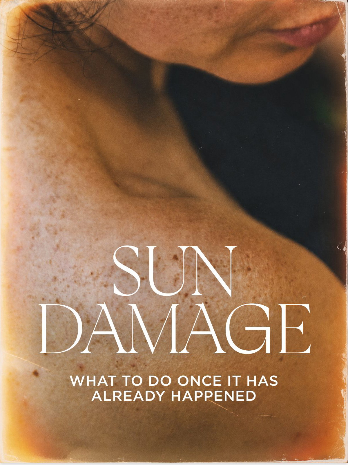 SUN DAMAGE TREATMENTS- DISCOVER MORE