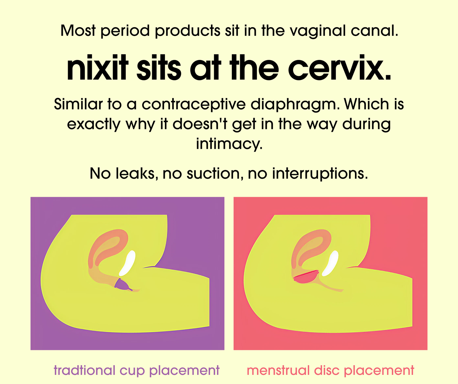 Most period products sit in the vaginal canal. nixit sits at the cervix. Similar to a contraceptive diaphragm. Which is exactly why it doesn't get in the way during intimacy. No leaks, no suction, no interruptions.