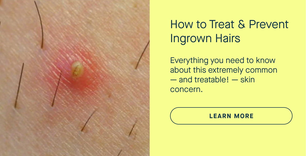 Learn More: Treat & Prevent Ingrown Hairs