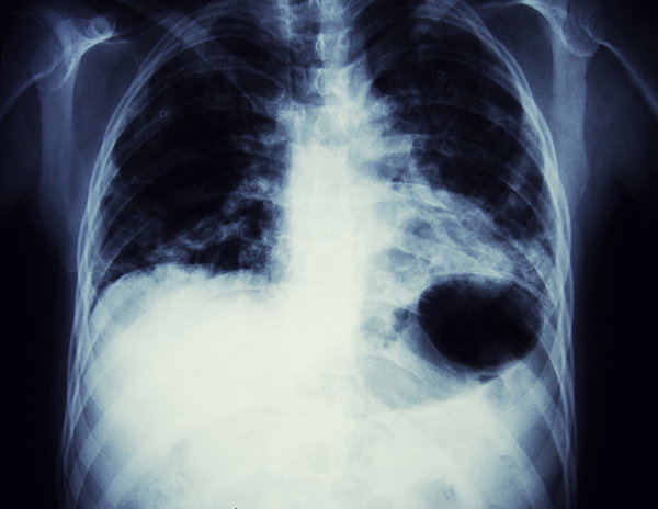 An X-ray of a lung tumour.