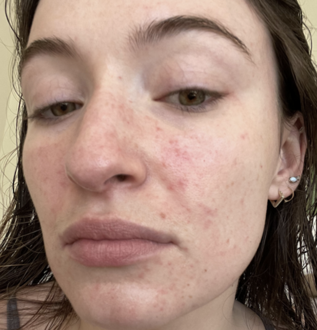 Emmy has dealt with her fair share of breakouts